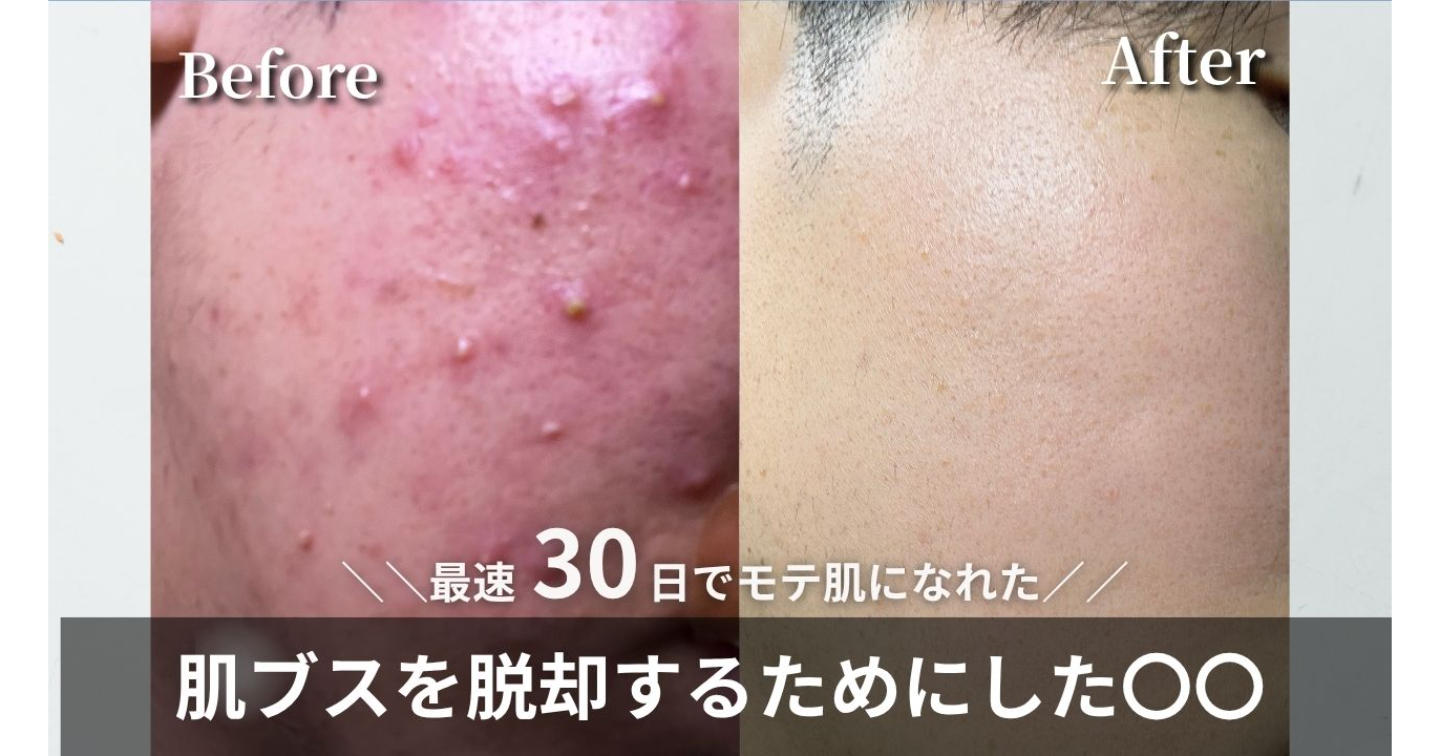 ~2025年最新版~科学的根拠に基づくニキビの治し方【全額返金保証💰】